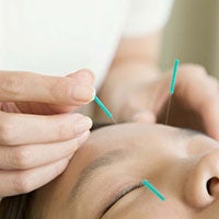 美容鍼灸とは？美容鍼灸の効果と鍼灸針の基礎知識