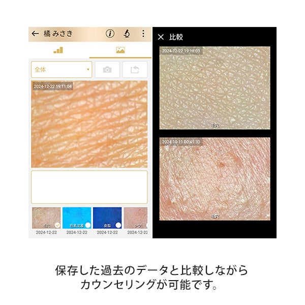 肌カウンセリングスコープ ASM