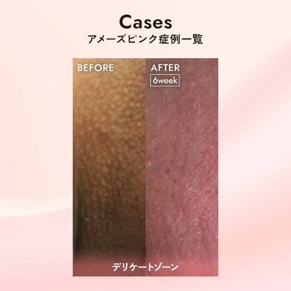 [アメーズピンク] セラム1 5mL (6本セット)