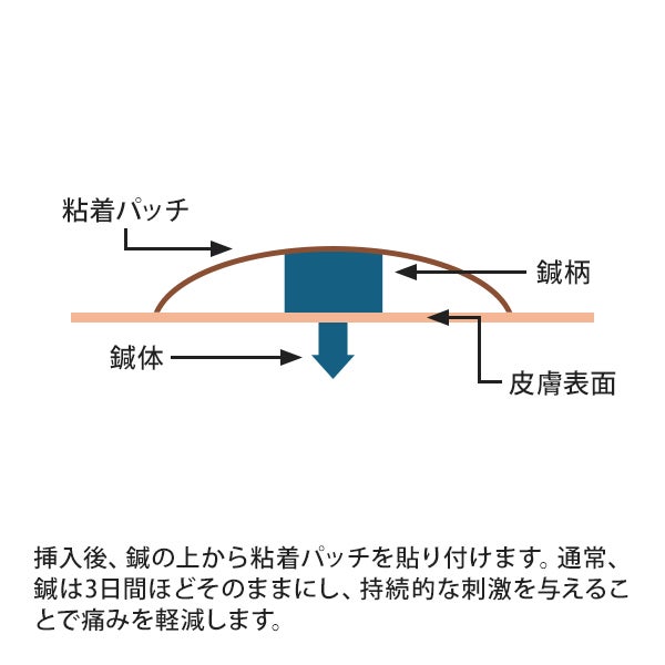 ASPニードル